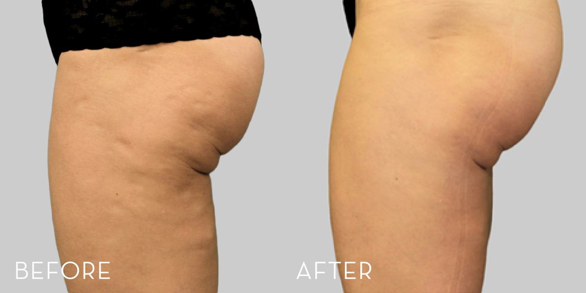 Before and After EXILIS ELITE treatment of thighs