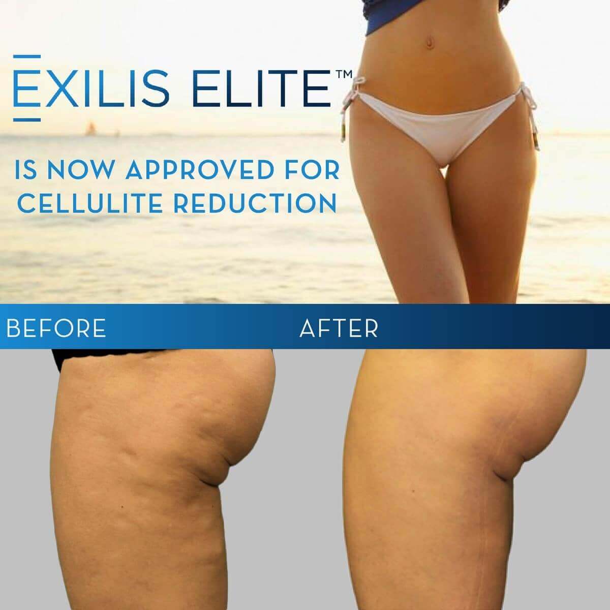 Exilis ELITE Granted FDA Clearance for Treatment to Reduce the Appearance of Cellulite 1