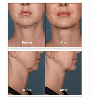 EliminatingtheDreadedDoubleChinwithKybella™Injections