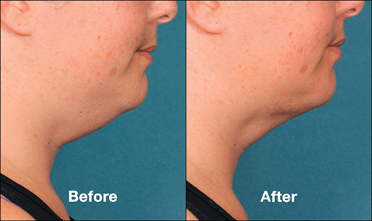 KYBELLA FAQ 2 img 1
