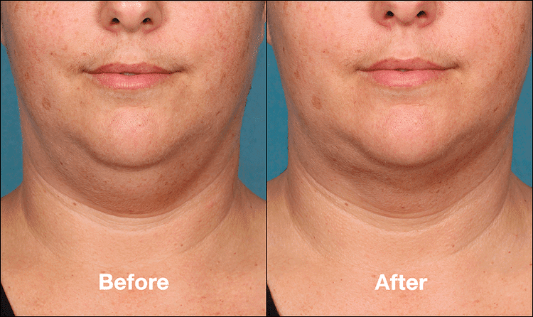 KYBELLA FAQ 3 img 2
