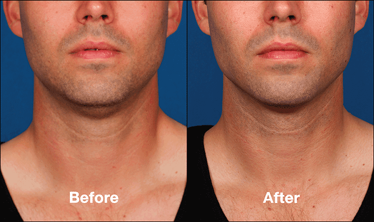 KYBELLA FAQ 4 img 3