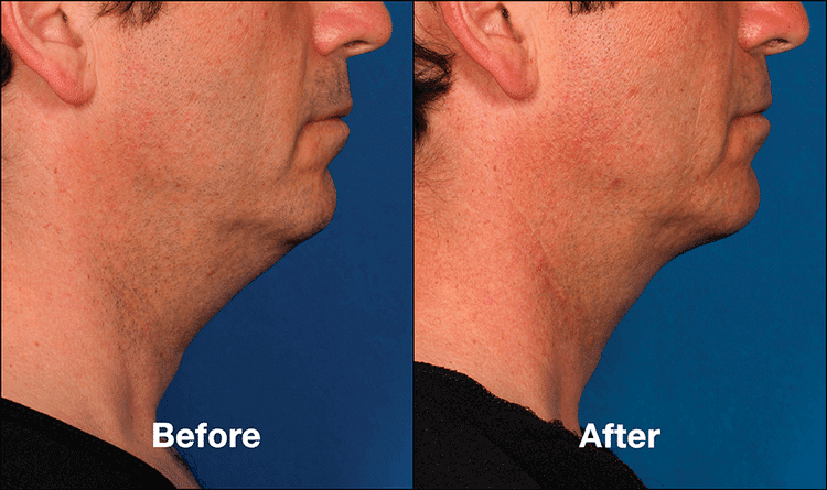 KYBELLA FAQ 1 img