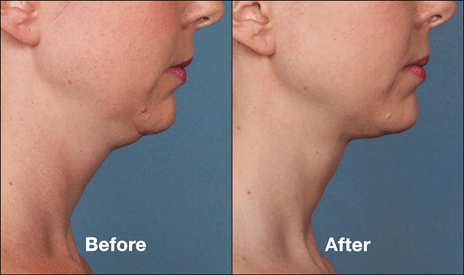 KybellaPatientPRI1BeforeAfter(SideView) Kybella