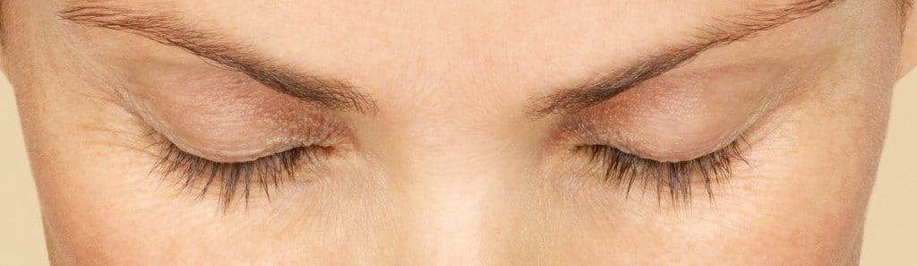 Before Latisse treatment