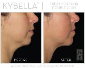 KYBELLA® before & after