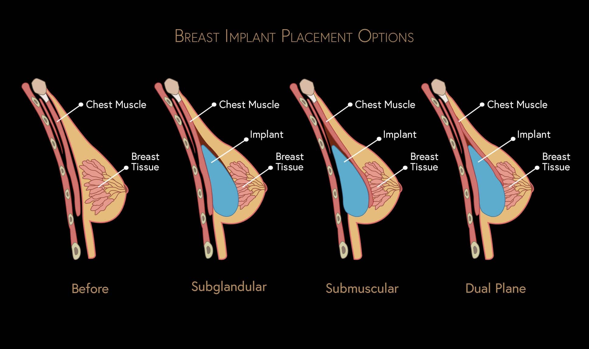 Breast Augmentation in Nashville, TN - Nashville Cosmetic Surgery