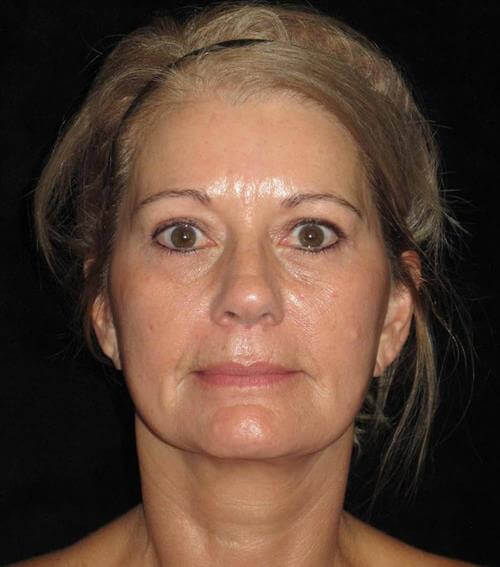 Facelift Patient Photo - Case 245 - after view