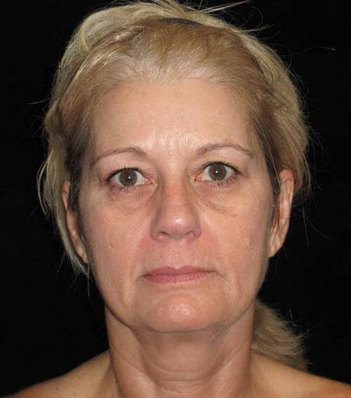 Facelift Patient Photo - Case 245 - before view-