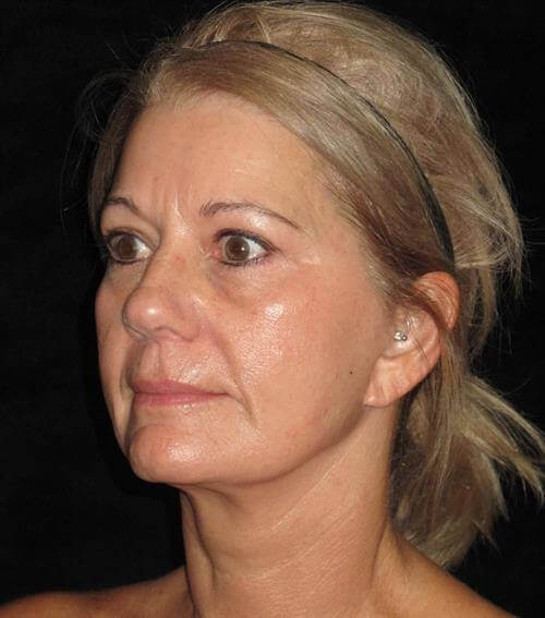 Facelift Patient Photo - Case 245 - after view-1