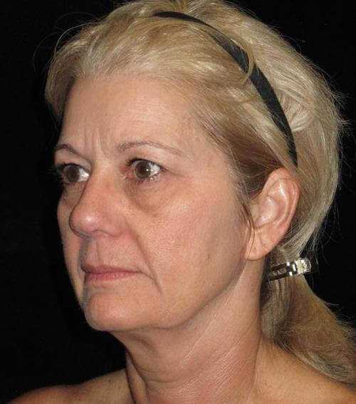 Facelift Patient Photo - Case 245 - before view-1