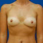 Breast Augmentation - Case 92 - Before