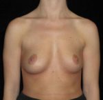 Breast Augmentation - Case 153 - Before