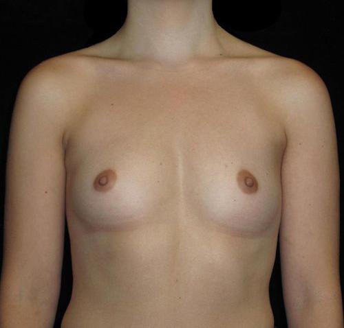 Breast Augmentation Patient Photo - Case 126 - before view-0