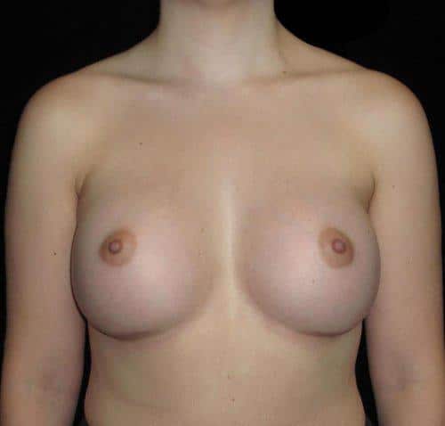 Breast Augmentation Patient Photo - Case 126 - after view
