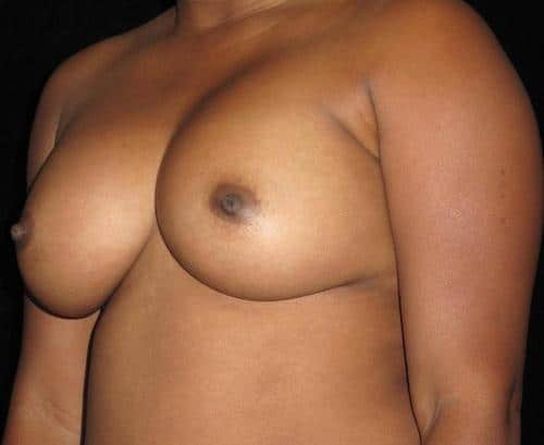 Breast Augmentation Patient Photo - Case 140 - after view-1