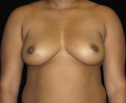 Breast Augmentation Patient Photo - Case 140 - before view-