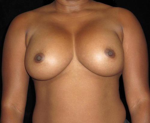 Breast Augmentation Patient Photo - Case 140 - after view