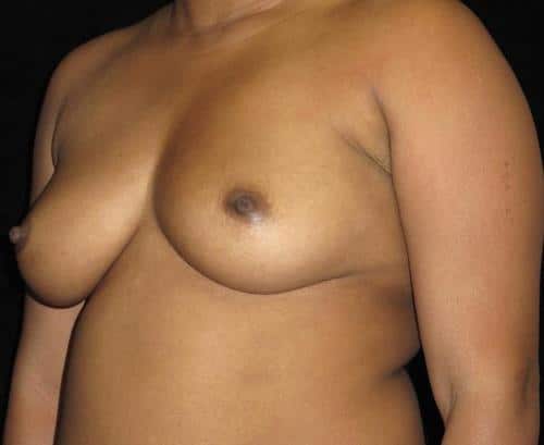 Breast Augmentation Patient Photo - Case 140 - before view-1