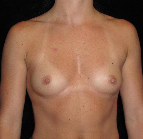 Breast Augmentation Patient Photo - Case 143 - before view-