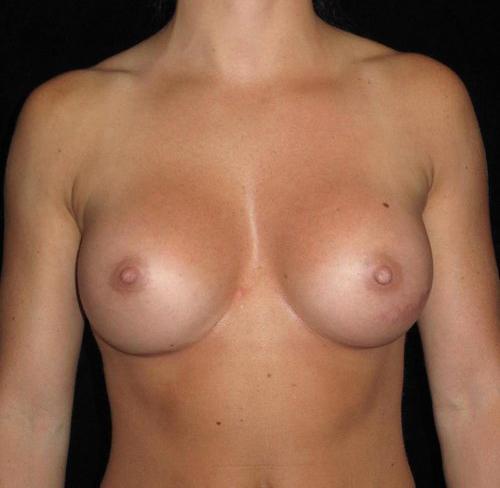 Breast Augmentation Patient Photo - Case 143 - after view-0