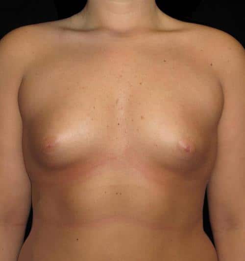 Breast Augmentation Patient Photo - Case 130 - before view-0