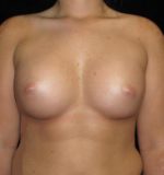 Breast Augmentation - Case 130 - After