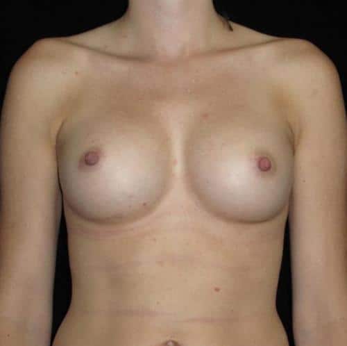 Breast Asymmetry Patient Photo - Case 132 - after view