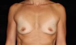 Breast Asymmetry - Case 238 - Before
