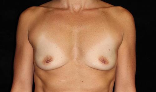 Breast Asymmetry Patient Photo - Case 238 - before view-