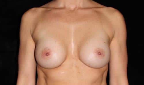 Breast Asymmetry Patient Photo - Case 238 - after view