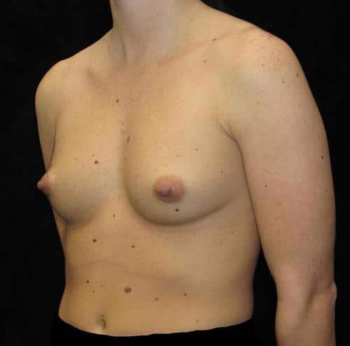 Breast Asymmetry Patient Photo - Case 104 - before view-1