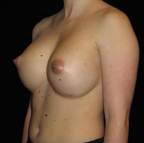 Breast Asymmetry Patient Photo - Case 104 - after view-1