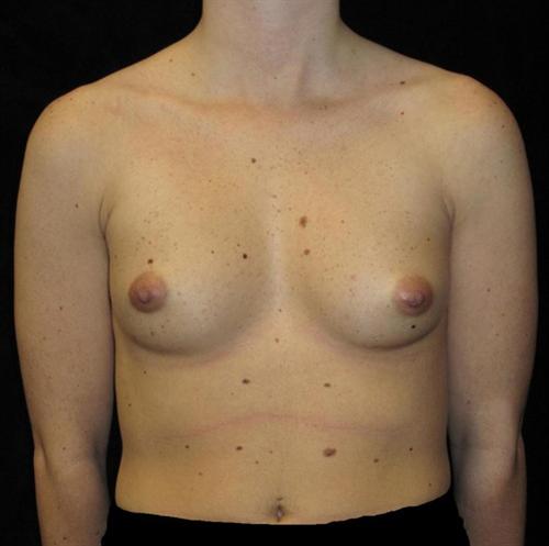 Breast Asymmetry Patient Photo - Case 104 - before view-0