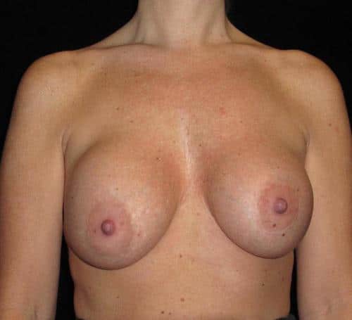 Breast Asymmetry Patient Photo - Case 124 - before view-