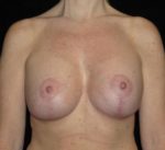 Breast Asymmetry - Case 124 - After