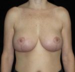 Breast Asymmetry - Case 145 - After