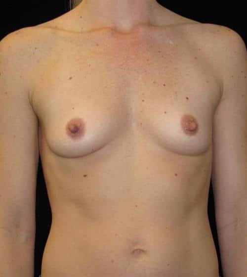 Breast Augmentation Patient Photo - Case 107 - before view-