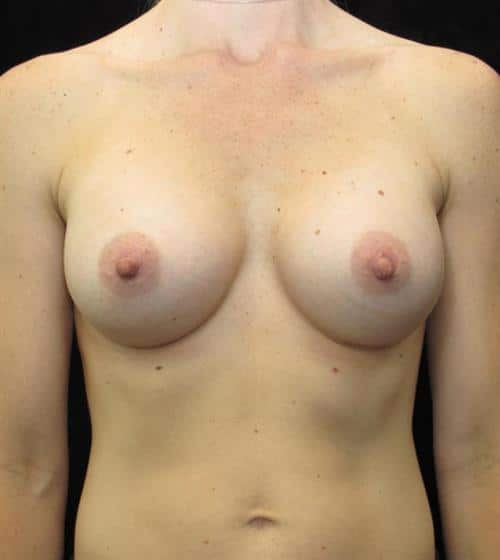 Breast Augmentation Patient Photo - Case 107 - after view