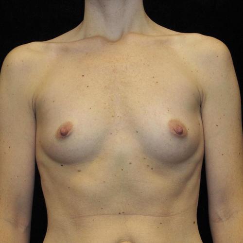 Breast Augmentation Patient Photo - Case 98 - before view-