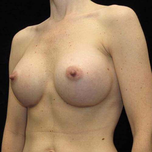Breast Augmentation Patient Photo - Case 98 - after view-1