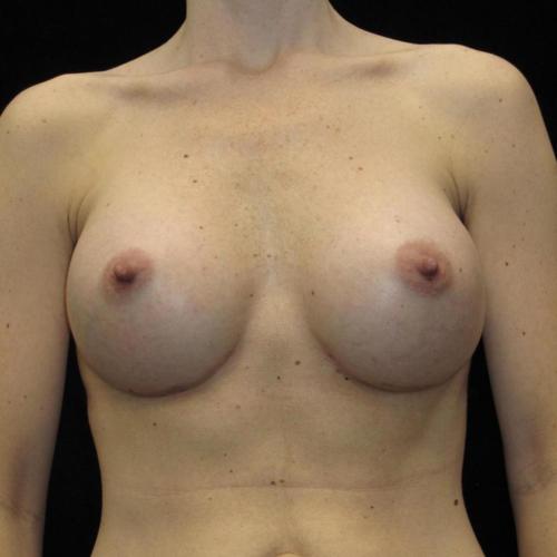Breast Augmentation Patient Photo - Case 98 - after view-0