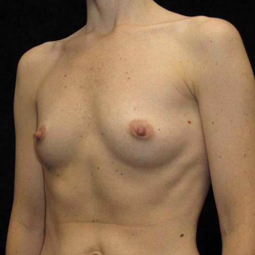 Breast Augmentation Patient Photo - Case 98 - before view-1