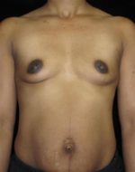 Breast Augmentation - Case 117 - Before