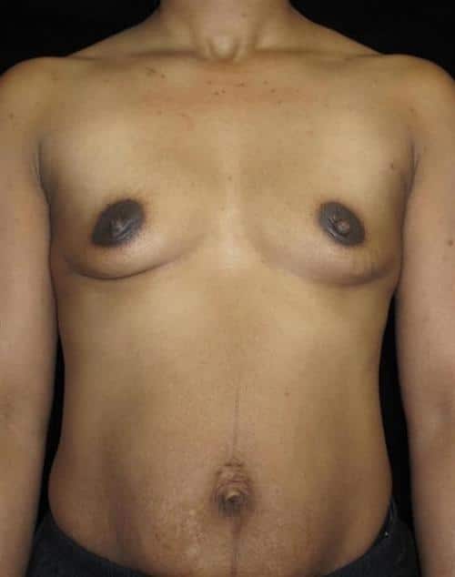 Breast Augmentation Patient Photo - Case 117 - before view-