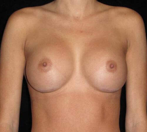 Breast Augmentation Patient Photo - Case 141 - after view-0
