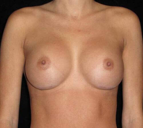 Breast Augmentation Patient Photo - Case 141 - after view