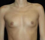 Breast Augmentation - Case 141 - Before