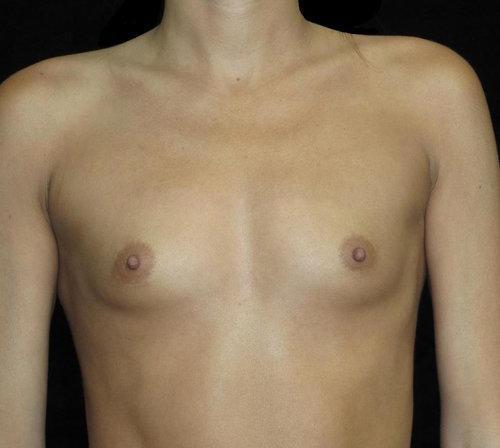 Breast Augmentation Patient Photo - Case 141 - before view-