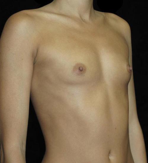 Breast Augmentation Patient Photo - Case 141 - before view-1